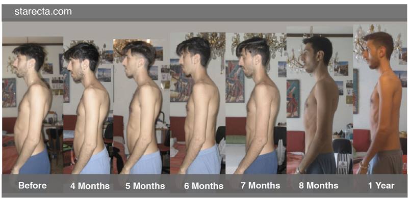 evolution posture starecta