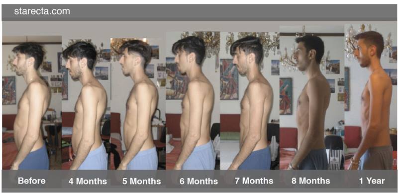 Lumbar Lordosis: How to Solve it permanently? 