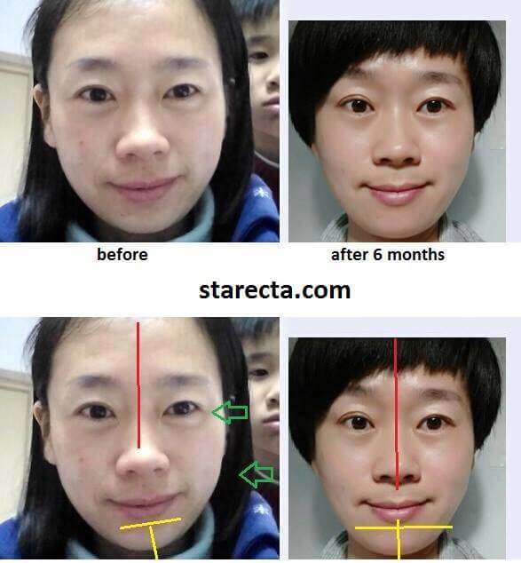 teeth facial symmetry