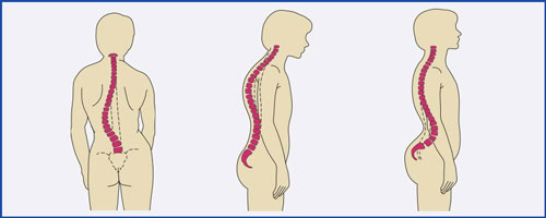 hyperlordosis-kyphosis