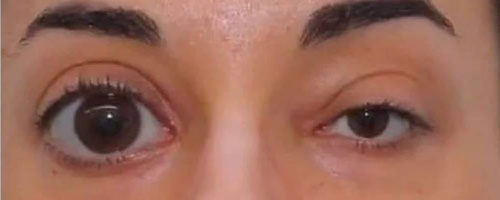Uneven eyes clearance